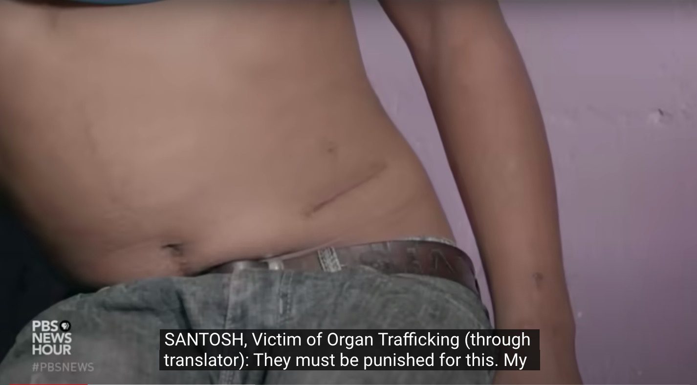 Human trafficking victims forced to sell their organs share harrowing stories